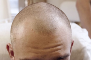 Трансплантация собственных волос головы – отзывы мужчин